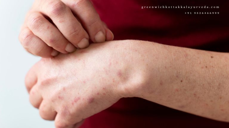 Psoriasis treatment in kerala