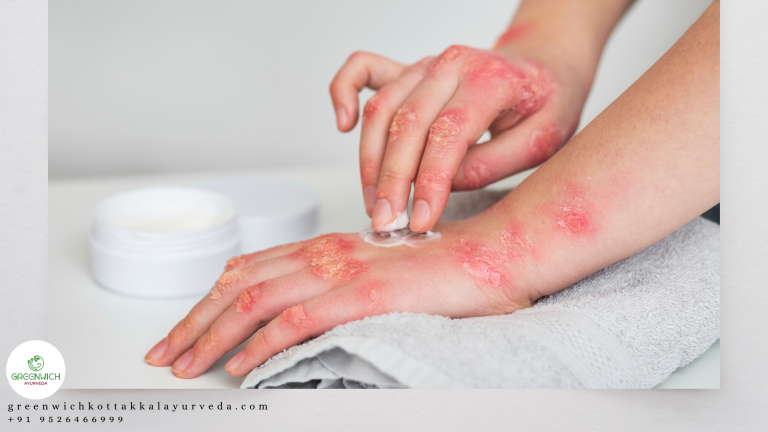 Best Ayurvedic hospital in Kerala for psoriasis