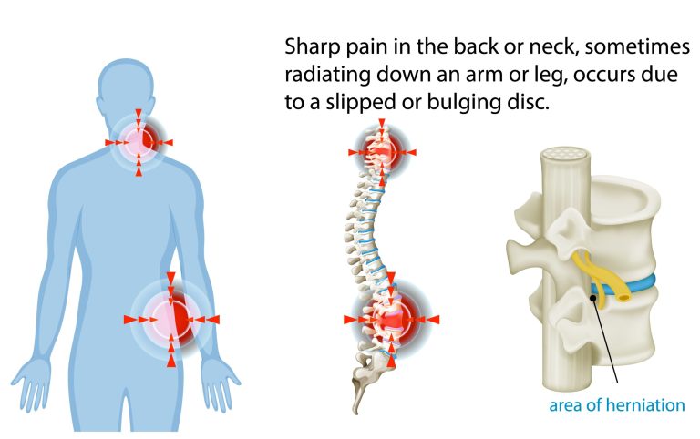 Holistic Ayurvedic treatment to strengthen the spine and ease pain.